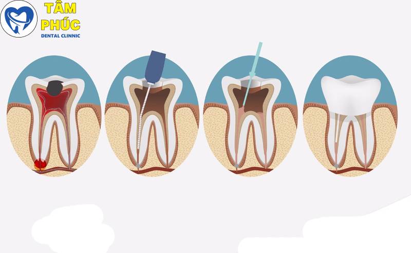 điều trị tủy an toàn không đau