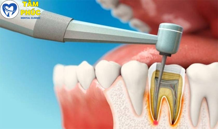 điều trị tủy an toàn không đau