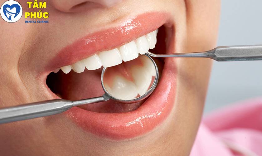Trám răng thẩm mỹ uy tín tại Tâm Phúc