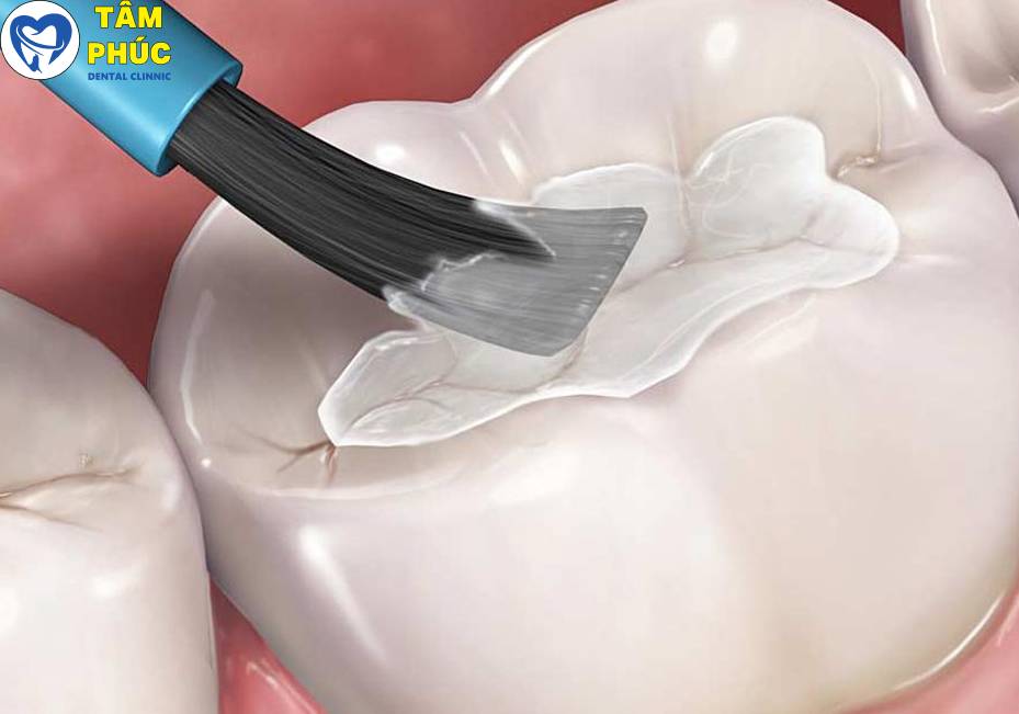 Trám răng thẩm mỹ uy tín tại Tâm Phúc