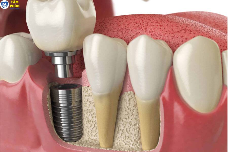 cấy ghép implant chất lượng cao