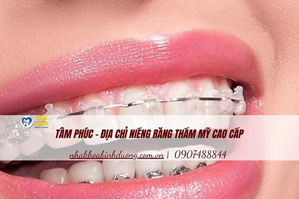 niềng răng thẩm mỹ cao cấp