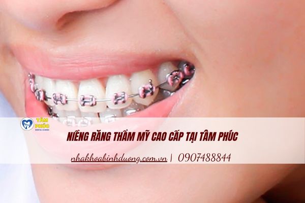 niềng răng thẩm mỹ cao cấp