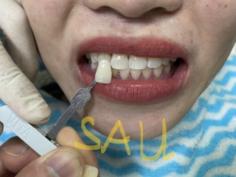  Hình Ảnh Trước Và Sau Khi Làm Răng