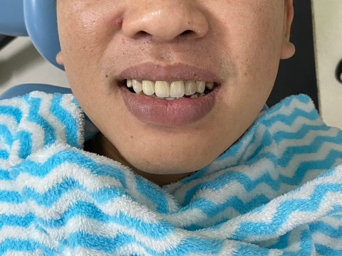 Trước Và Sau Khi Sử Dụng Dịch Vụ Ở Nha Khoa Tâm Phúc