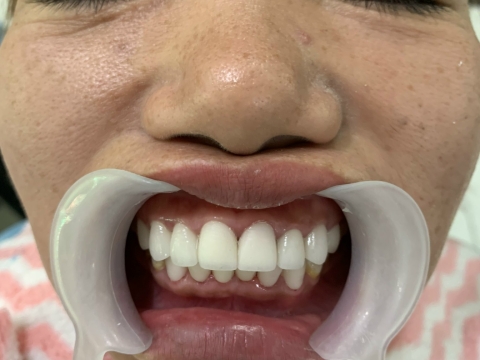  Hình Ảnh Trước Và Sau Khi Làm Răng