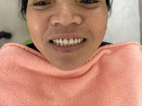  Hình Ảnh Trước Và Sau Khi Làm Răng