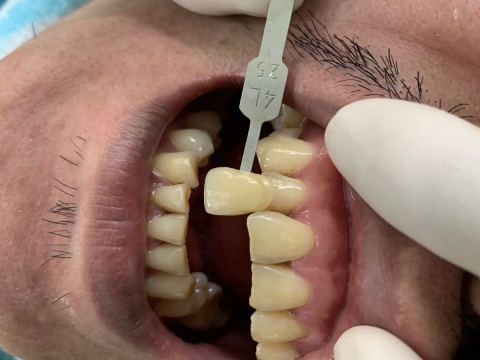  Hình Ảnh Trước Và Sau Khi Làm Răng