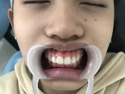  Hình Ảnh Trước Và Sau Khi Làm Răng