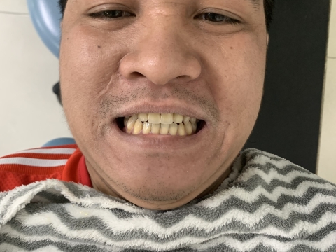  Hình Ảnh Trước Và Sau Khi Làm Răng