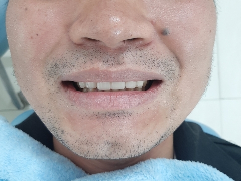  Hình Ảnh Trước Và Sau Khi Làm Răng