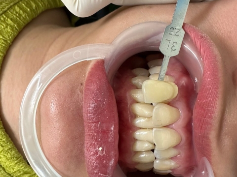 Hình Ảnh Làm Răng Tại Nha Khoa Tâm Phúc