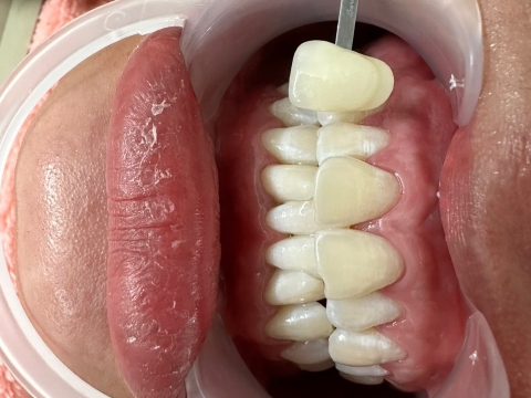 Hình Ảnh Làm Răng Tại Nha Khoa Tâm Phúc