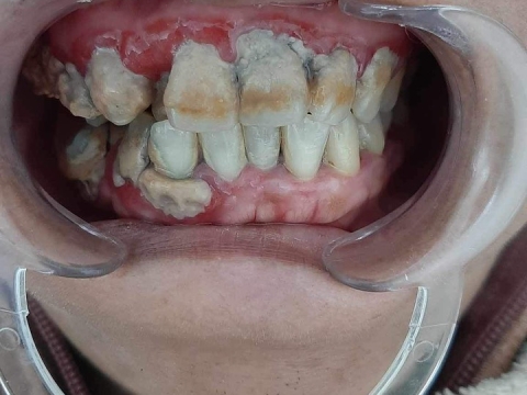 Hình Ảnh Làm Răng Tại Nha Khoa Tâm Phúc