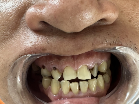 Hình Ảnh Làm Răng Tại Nha Khoa Tâm Phúc