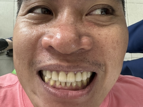 Hình Ảnh Làm Răng Tại Nha Khoa Tâm Phúc