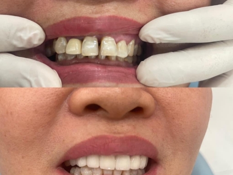 Hình Ảnh Làm Răng Tại Nha Khoa Tâm Phúc