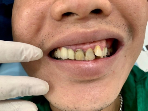 Hình Ảnh Làm Răng Tại Nha Khoa Tâm Phúc