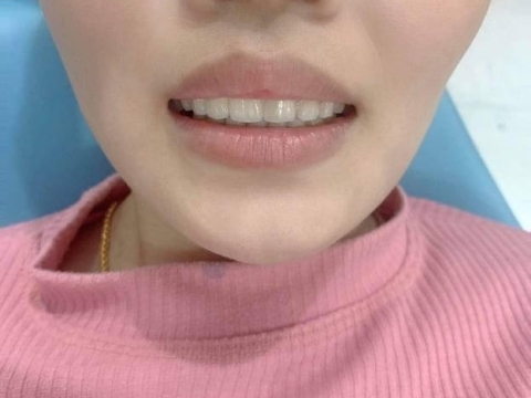 Hình Ảnh Làm Răng Tại Nha Khoa Tâm Phúc