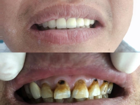 Hình Ảnh Làm Răng Tại Nha Khoa Tâm Phúc