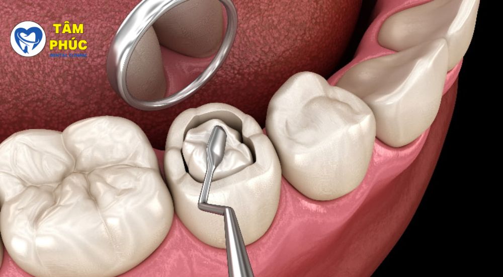 Trám răng 99k tại Bình Dương