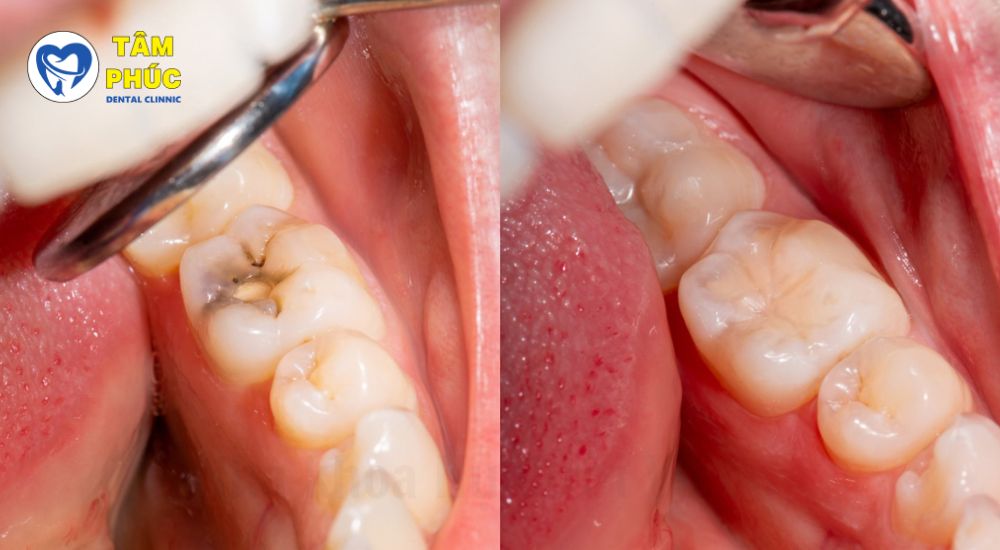 Nha Khoa Tâm Phúc để trám răng 99k tại Bình Dương