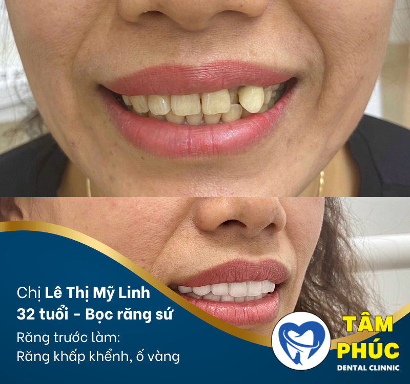 Bọc sứ cho răng lệch là giải pháp tối ưu để điều chỉnh răng bị lệch lạc hoặc khấp khểnh. 
