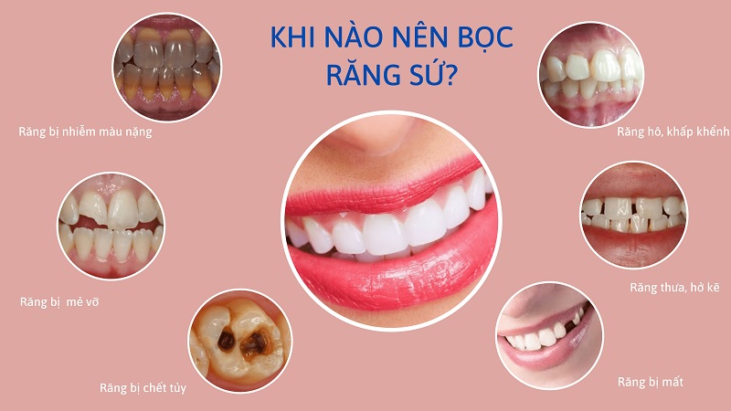 Làm đẹp răng, khắc phục tình trạng răng ố vàng, màu sắc không đều. 