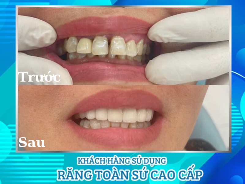 Bọc răng sứ thẩm mỹ tại Nha Khoa Bình Dương mang lại vẻ đẹp tự nhiên, màu sắc giống răng thật. 