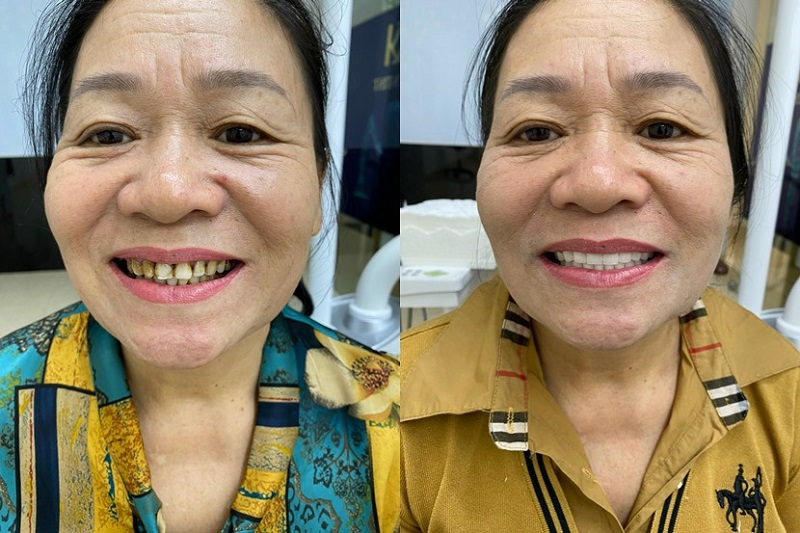Tại Nha Khoa Tâm Phúc, chúng tôi sử dụng các thiết bị hiện đại và phương pháp tiên tiến để cạo vôi răng.