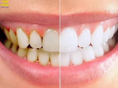 Dịch vụ cạo vôi răng nha khoa uy tín tại Tâm Phúc