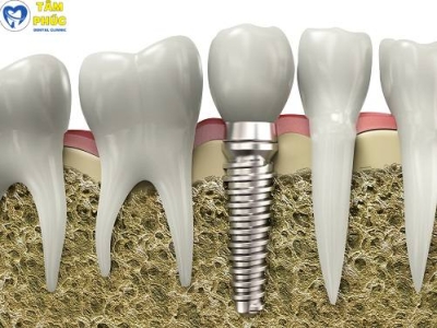 Dịch vụ cấy ghép implant chất lượng cao tại Tâm Phúc