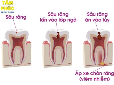 Dịch vụ điều trị tủy an toàn không đau tại Tâm Phúc