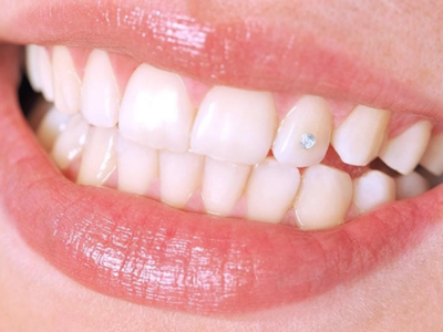 Đính đá lên răng - Nha Khoa Tâm Phúc