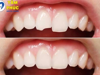Trám răng thẩm mỹ uy tín tại Tâm Phúc