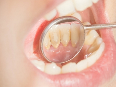 Dịch vụ vệ sinh cạo vôi răng Nha Khoa Tâm Phúc