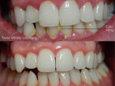 VỆ SINH VÔI RĂNG