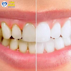 Dịch vụ cạo vôi răng nha khoa uy tín tại Tâm Phúc