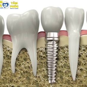 Dịch vụ cấy ghép implant chất lượng cao tại Tâm Phúc