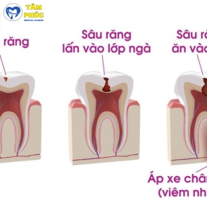 Dịch vụ điều trị tủy an toàn không đau tại Tâm Phúc