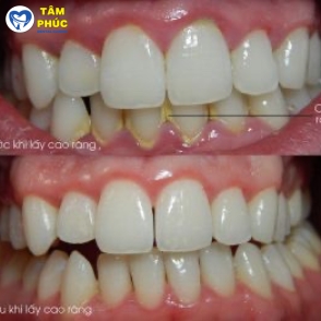 VỆ SINH VÔI RĂNG